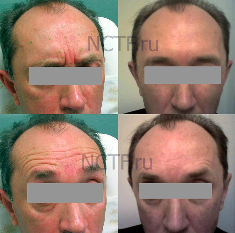 Ботокс мужчине - фото до и после