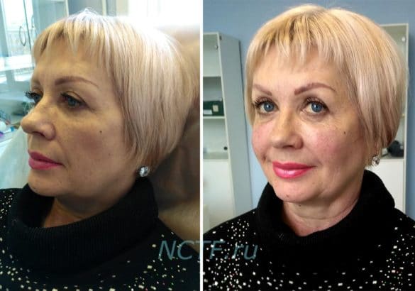 коррекция носослезной борозды фото до и после
